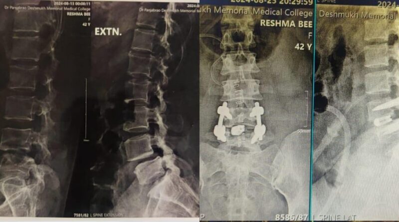 Spinal bone workshop concluded at Dr. Panjabrao Deshmukh Medical College and Hospital